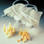 Incontinenta urinara