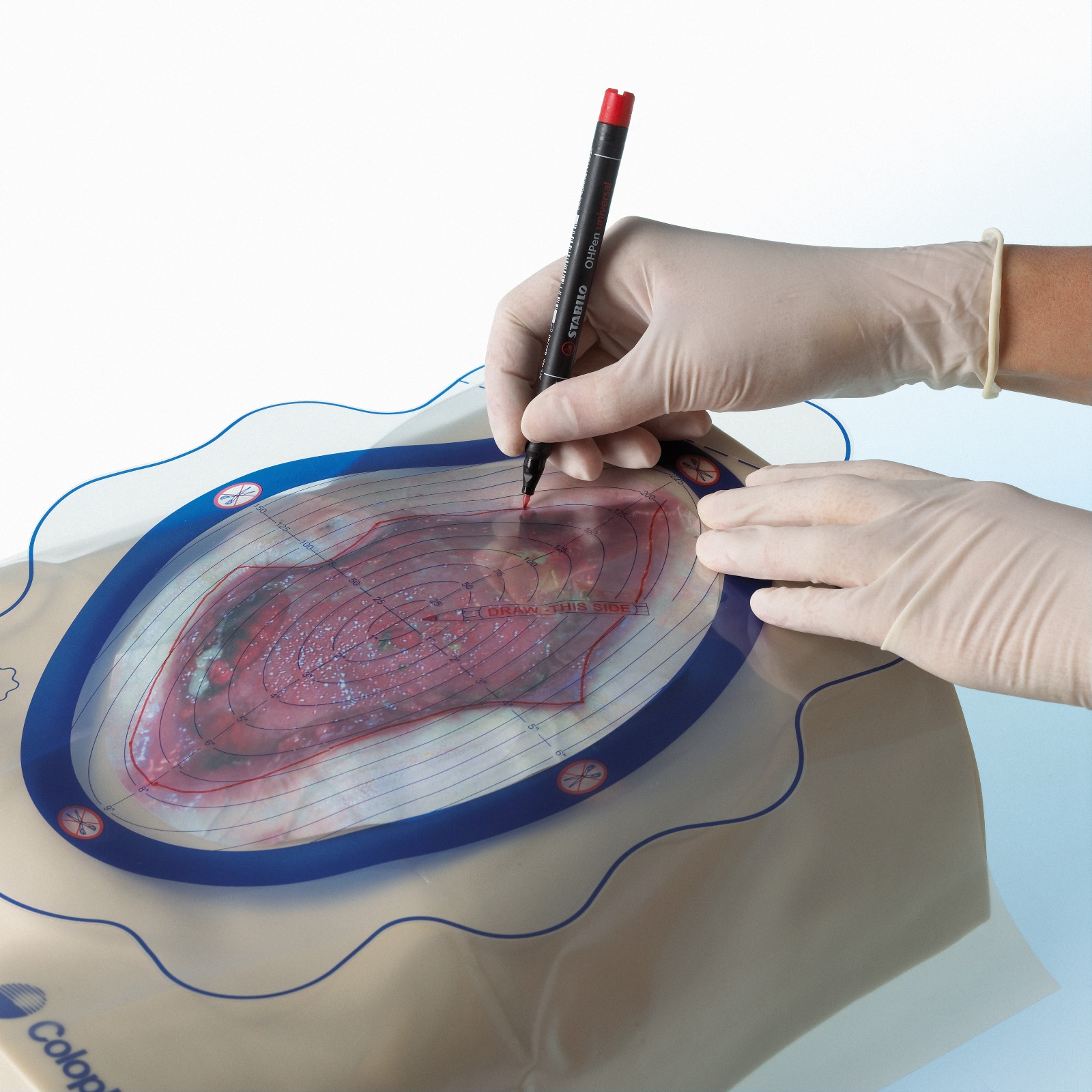 Sac colector cu evacuare pentru fistule Sac colector cu evacuare pentru fistule